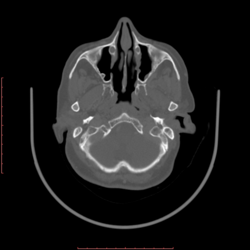 Chronic osteomyelitis - maxilla (Radiopaedia 23783-23927 Axial bone window 113).jpg