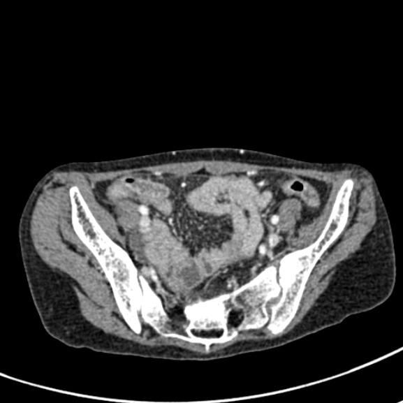 Chronic pancreatitis (Radiopaedia 55405-61846 A 84).jpg