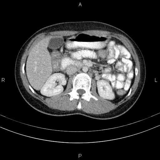 Chronic pancreatitis (Radiopaedia 64576-73450 C 66).jpg