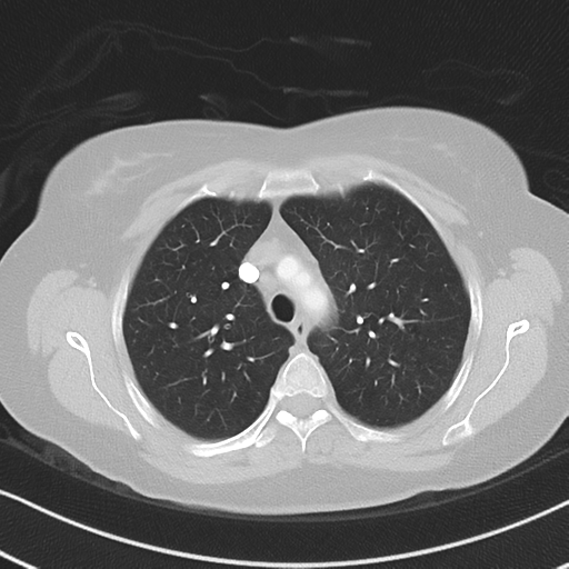 Chronic pulmonary embolus (Radiopaedia 39129-41341 Axial lung window 19).png