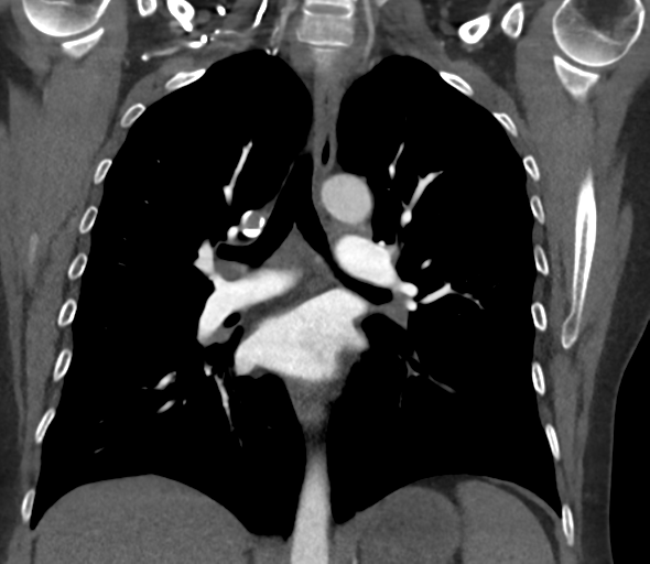 File:Chronic pulmonary embolus (Radiopaedia 39129-41341 Coronal C+ CTPA 49).png