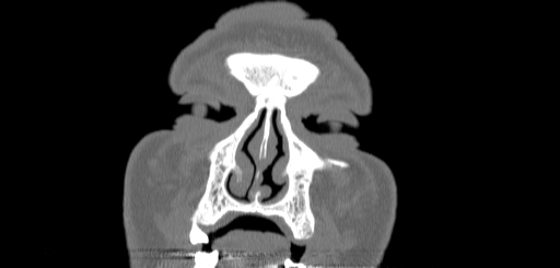 Chronic sphenoidal sinusitis (Radiopaedia 62030-70122 Coronal bone window 12).jpg