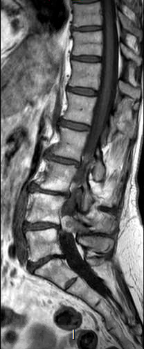 File:Chronic spinal hematoma with cauda equina syndrome (Radiopaedia 75745-87090 Sagittal T1 9).png