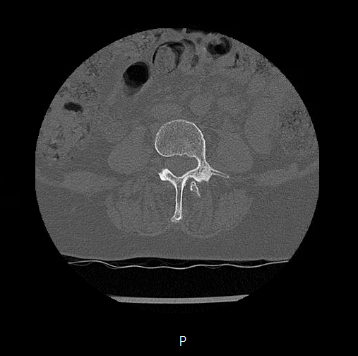 File:Chronic spinal hematoma with cauda equina syndrome (Radiopaedia 75745-88197 Axial bone window 28).png