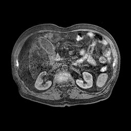 Cirrhosis and hepatocellular carcinoma in the setting of hemochromatosis (Radiopaedia 75394-86594 Axial T1 C+ fat sat 22).jpg