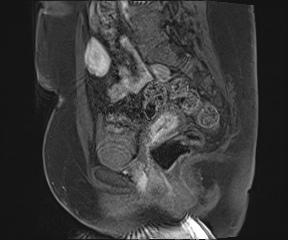 Class II Mullerian duct anomaly- unicornuate uterus with rudimentary horn and non-communicating cavity (Radiopaedia 39441-41755 G 49).jpg