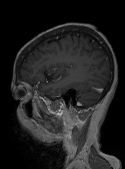 Clival meningioma (Radiopaedia 53278-59248 Sagittal T1 C+ 331).jpg