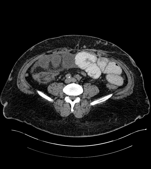 Closed-loop small bowel obstruction-internal hernia (Radiopaedia 78439-91096 Axial non-contrast 100).jpg