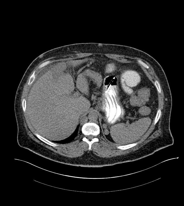 Closed-loop small bowel obstruction-internal hernia (Radiopaedia 78439-91096 Axial non-contrast 35).jpg