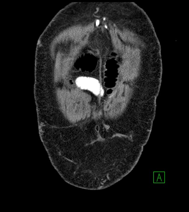 Closed-loop small bowel obstruction-internal hernia (Radiopaedia 78439-91096 Coronal non-contrast 17).jpg