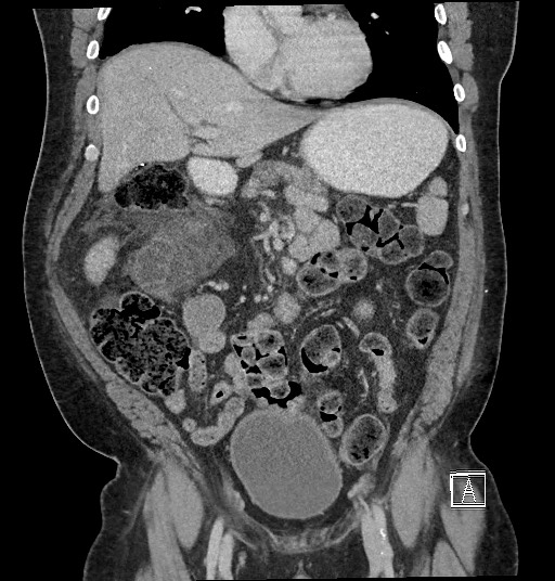 Closed loop obstruction - internal hernia into nephrectomy bed (Radiopaedia 59867-67320 B 54).jpg