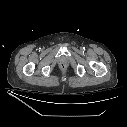 File:Closed loop obstruction due to adhesive band, resulting in small bowel ischemia and resection (Radiopaedia 83835-99023 B 159).jpg