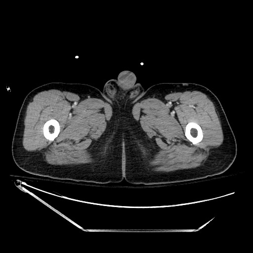 File:Closed loop obstruction due to adhesive band, resulting in small bowel ischemia and resection (Radiopaedia 83835-99023 D 186).jpg