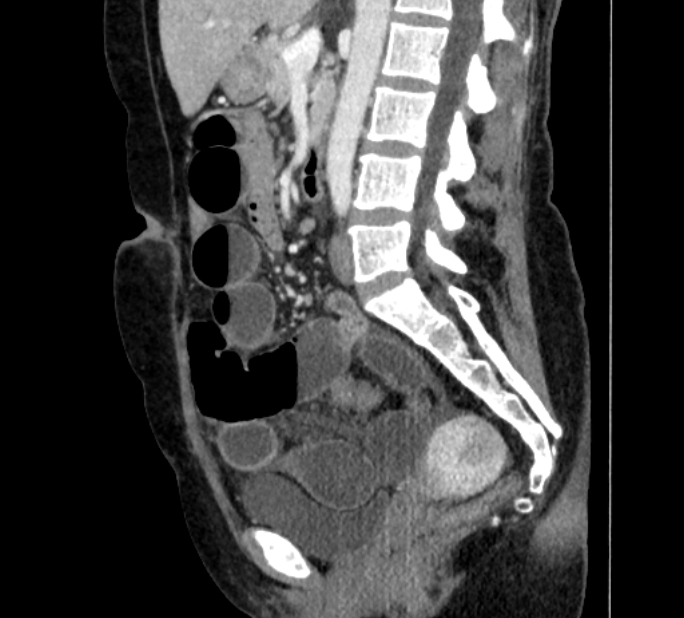 Closed loop small bowel obstruction (Radiopaedia 71211-81508 C 78).jpg