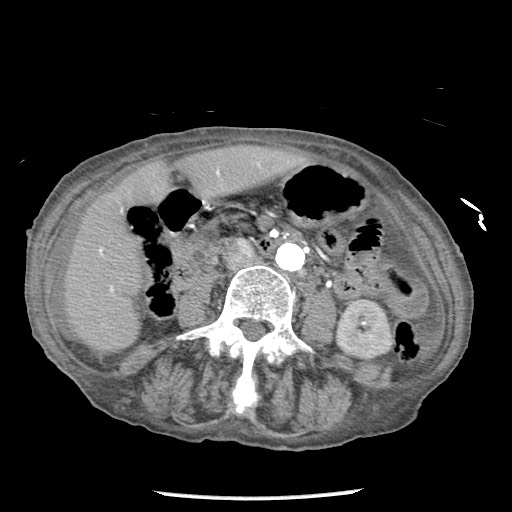 File:Closed loop small bowel obstruction - adhesions and infarct (Radiopaedia 85125-100678 A 86).jpg