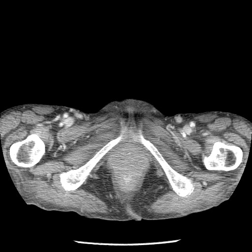Closed loop small bowel obstruction - adhesions and infarct (Radiopaedia 85125-100678 B 116).jpg