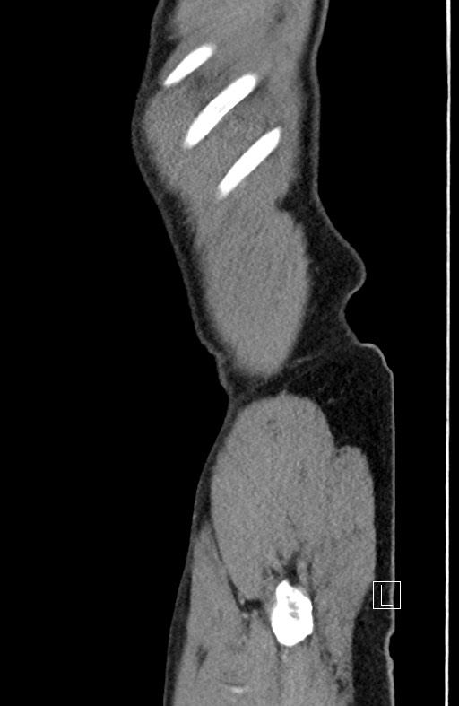 Closed loop small bowel obstruction - internal hernia (Radiopaedia 57806-64778 C 9).jpg