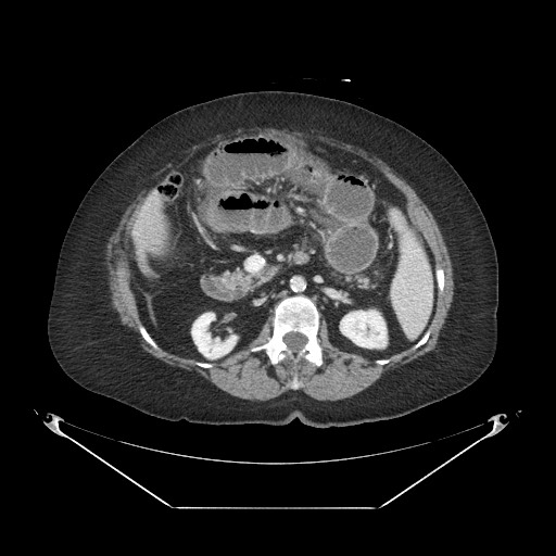Closed loop small bowel obstruction - internal hernia (Radiopaedia 65402-74450 A 50).jpg