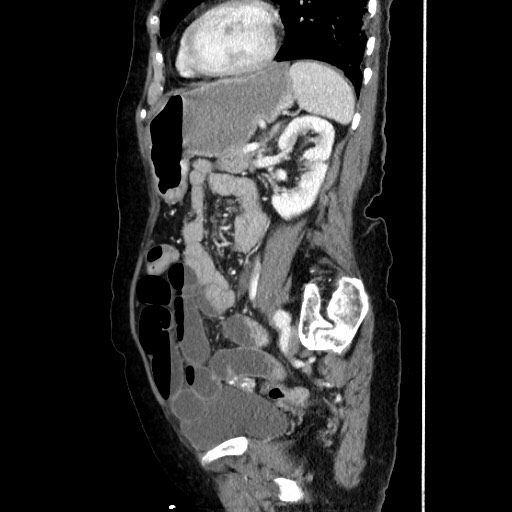 Closed loop small bowel obstruction due to adhesive band, with intramural hemorrhage and ischemia (Radiopaedia 83831-99017 D 127).jpg