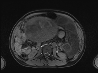 Closed loop small bowel obstruction in pregnancy (MRI) (Radiopaedia 87637-104031 Axial T1 fat sat 63).jpg