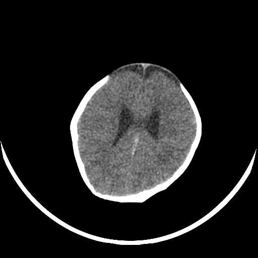 File:Cloverleaf shaped skull in the absence of craniosynostosis (Radiopaedia 21296-21216 Axial non-contrast 13).jpg