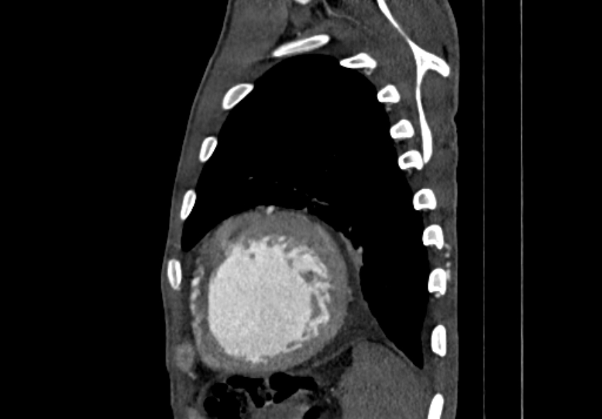 Coarctation of aorta with aortic valve stenosis (Radiopaedia 70463-80574 B 194).jpg