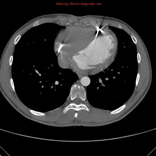File:Coarctation of the aorta (Radiopaedia 9434-10118 A 135).jpg