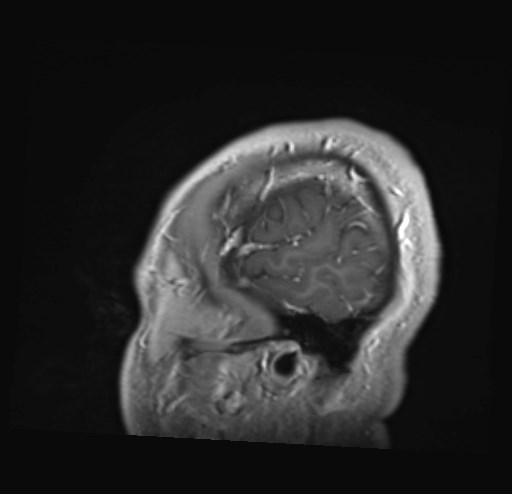 File:Cochlear incomplete partition type III associated with hypothalamic hamartoma (Radiopaedia 88756-105498 Sagittal T1 C+ 6).jpg
