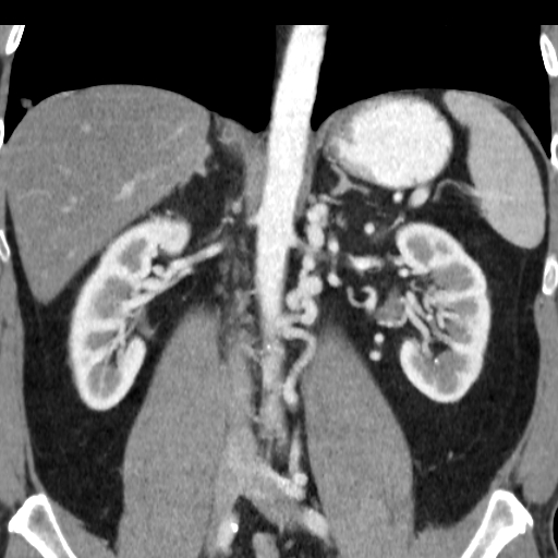 File:Collateral circulation following left renal vein thrombosis (Radiopaedia 17319-17013 renal cortical phase 12).jpg