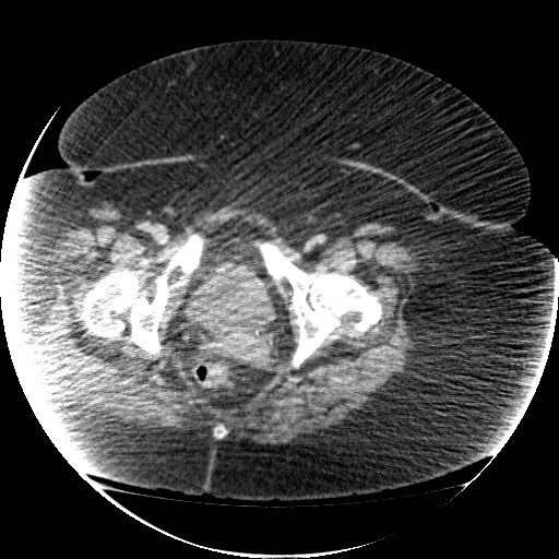 File:Collection due to leak after sleeve gastrectomy (Radiopaedia 55504-61972 A 78).jpg