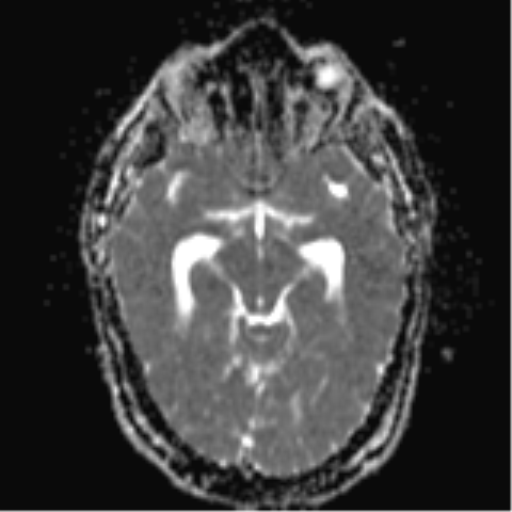 File:Colloid cyst (Radiopaedia 44510-48181 Axial ADC 11).png