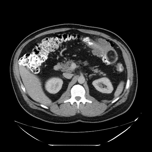 File:Colocolic intussusception due to lipoma (Radiopaedia 73712-84508 Axial 8).jpg