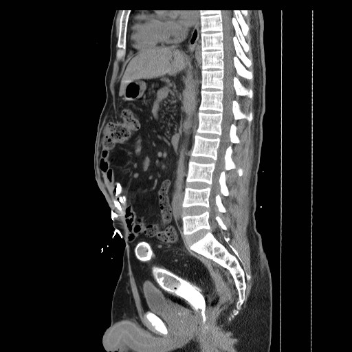 Colocutaneous fistula in Crohn's disease (Radiopaedia 29586-30093 F 15).jpg