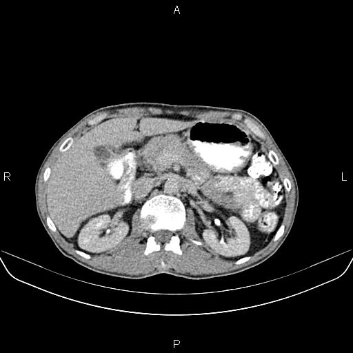 File:Colon adenocarcinoma - hepatic flexure (Radiopaedia 85635-101395 Axial C+ delayed 30).jpg