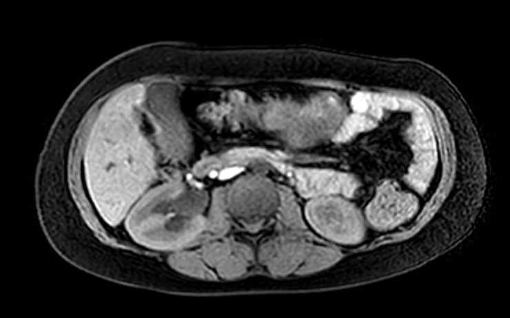 Colon adenocarcinoma with Krukenberg tumors, advanced pregnancy (Radiopaedia 67279-76645 A 50).jpg