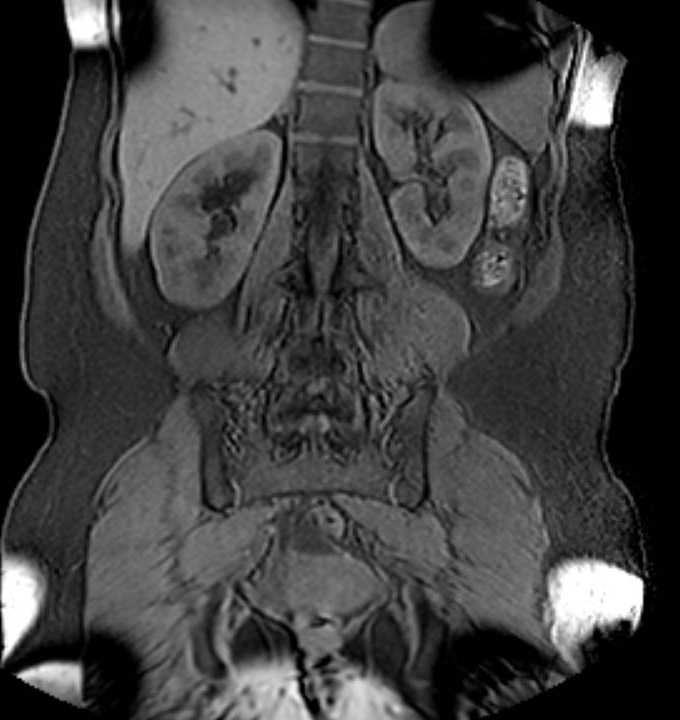 Colon adenocarcinoma with Krukenberg tumors, advanced pregnancy (Radiopaedia 67279-76645 E 70).jpg