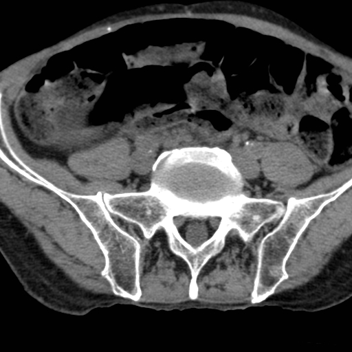 Colon cancer with calcified liver metastasis (Radiopaedia 74423-85309 Axial non-contrast 80).jpg