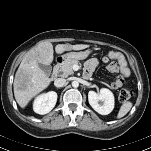 Colon carcinoma with hepatic metastases (Radiopaedia 29477-29961 A 40).jpg