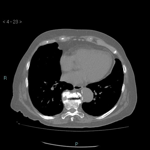 File:Colonic lipomas (Radiopaedia 49137-54244 Axial bone window 11).jpg