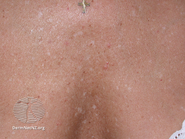File:Guttate hypomelanosis on the chest (DermNet NZ colour-igh1).jpg