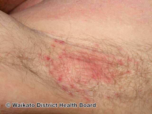 File:Intertrigo due to seborrhoeic dermatitis (DermNet NZ dermatitis-w-sebderm10).jpg