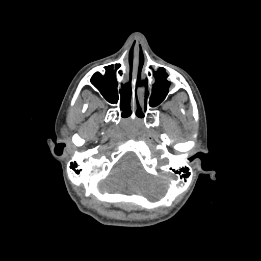 Nasal pyogenic granuloma (lobular capillary hemangioma) (Radiopaedia 85536-101244 Axial non-contrast 59).jpg