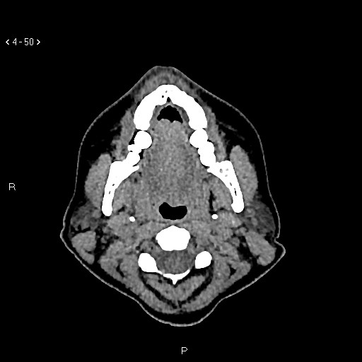 File:Nasolabial cyst (Radiopaedia 75125-86194 Axial non-contrast 12).jpg