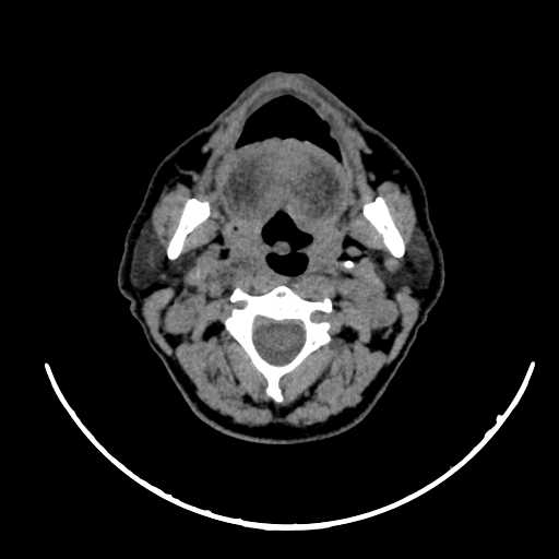 Nasopharyngeal carcinoma - infiltrating the clivus (Radiopaedia 62583-70875 Axial non-contrast 28).jpg