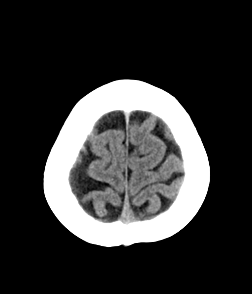 File:Nasopharyngeal carcinoma with cerebral abscess (Radiopaedia 43018-46275 Axial non-contrast 46).png