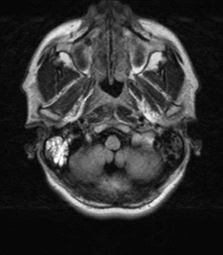 File:Nasopharyngeal carcinoma with pterygopalatine fossa involvement (Radiopaedia 33102-34134 Axial FLAIR 3).png
