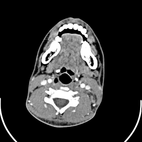 File:Nasopharyngeal carcinoma with skull base invasion (Radiopaedia 53415-59705 A 121).jpg