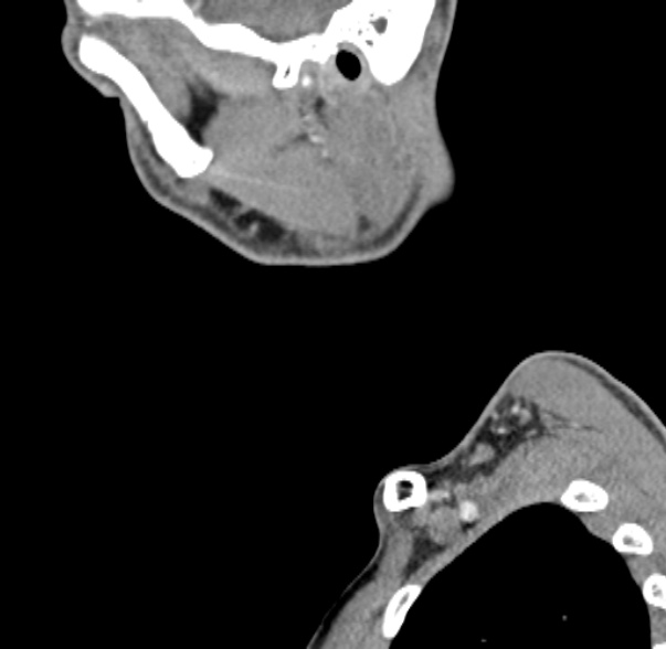 File:Nasopharyngeal carcinoma with skull base invasion (Radiopaedia 53415-59705 C 66).jpg