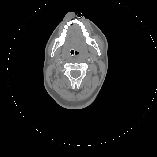 Neck CT angiogram (intraosseous vascular access) (Radiopaedia 55481-61945 B 213).jpg