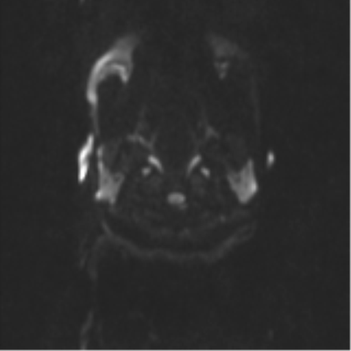 Neurenteric cyst (Radiopaedia 58641-65837 Axial DWI 35).png